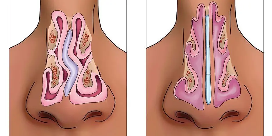 Curve of the nasal septum &#8211; causes, symptoms, treatment, surgery