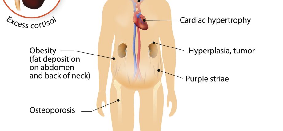 Cushing&#8217;s disease