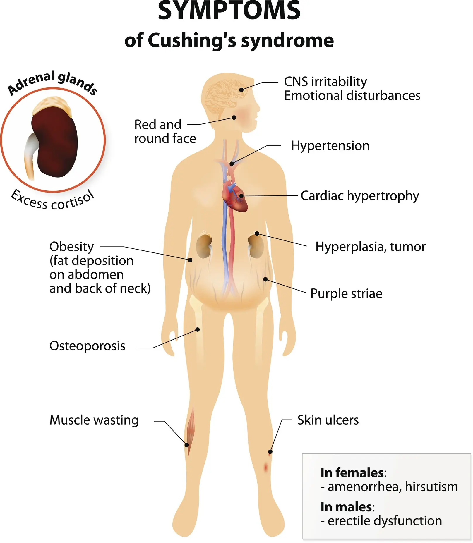 Cushing&#8217;s disease