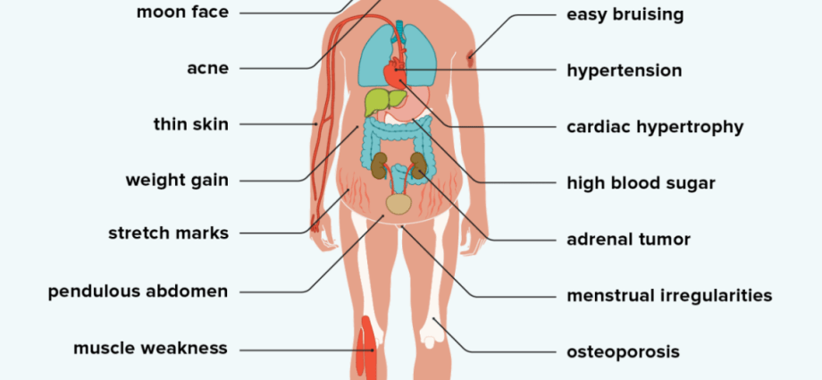 Cushing&#8217;s syndrome &#8211; causes, symptoms, treatment. Symptoms of Cushing&#8217;s syndrome in children