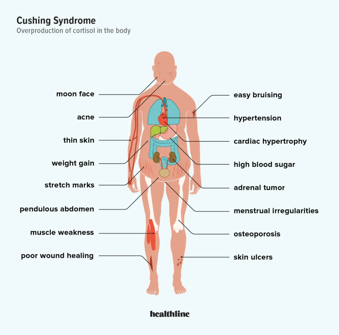 Cushing&#8217;s syndrome &#8211; causes, symptoms, treatment. Symptoms of Cushing&#8217;s syndrome in children