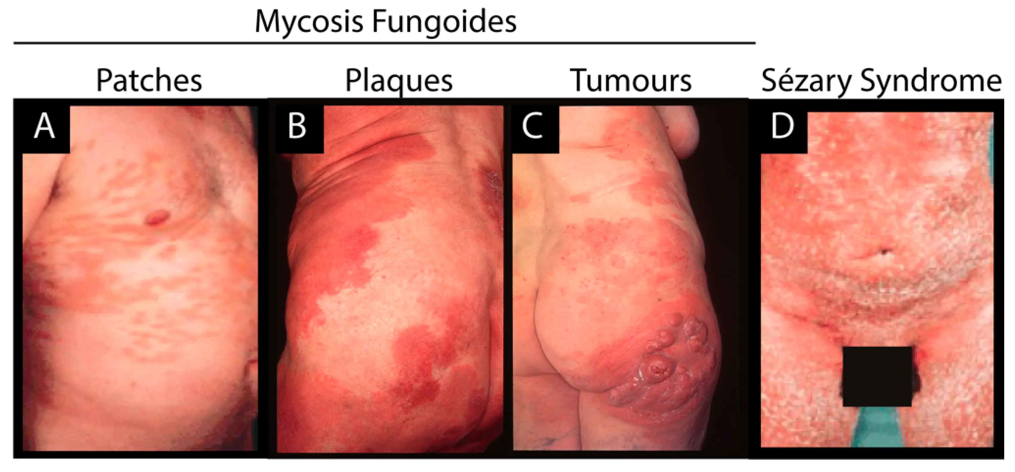 Cutaneous lymphoma &#8211; diagnosis and treatment of mycosis fungoides