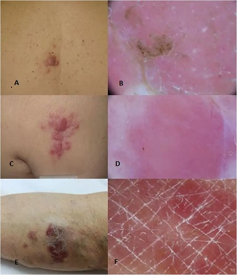 Cutaneous lymphomas