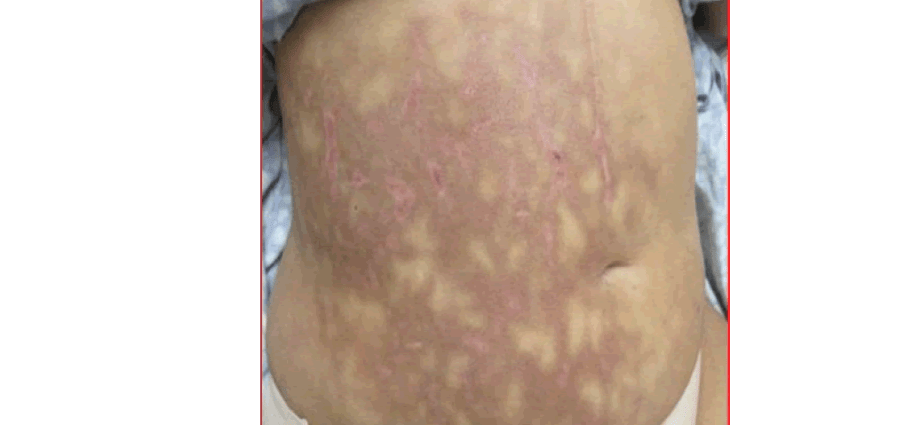 Cutaneous symptoms of a diseased pancreas