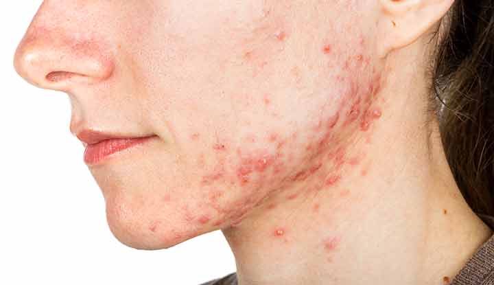 Cystic acne