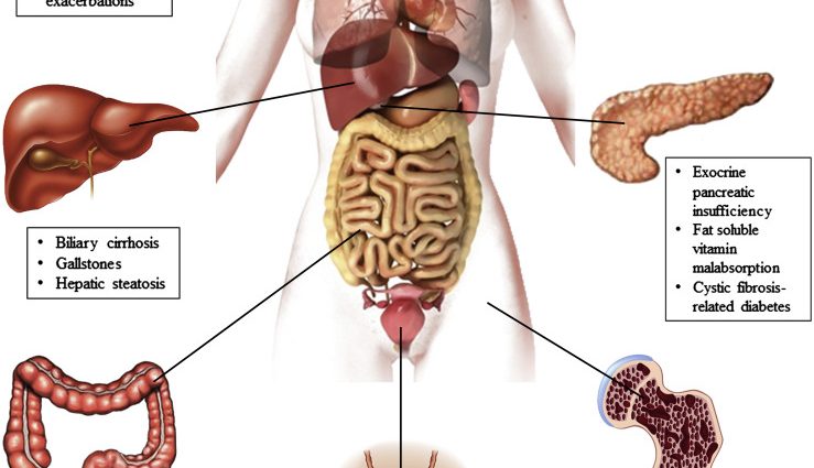 Cystic fibrosis acidifies the lungs