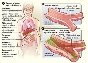 Cystic fibrosis &#8211; causes, symptoms, complications and treatment [EXPLAINED]