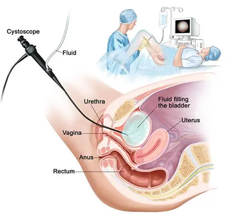 Cystography &#8211; examination of the bladder. When is it performed?