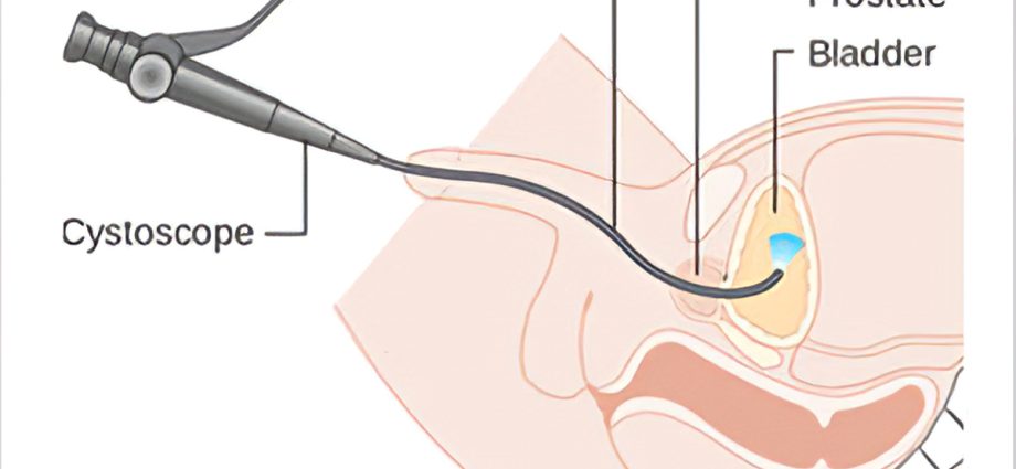 Cystoscopy &#8211; indications, price, course of examination. What are the complications?