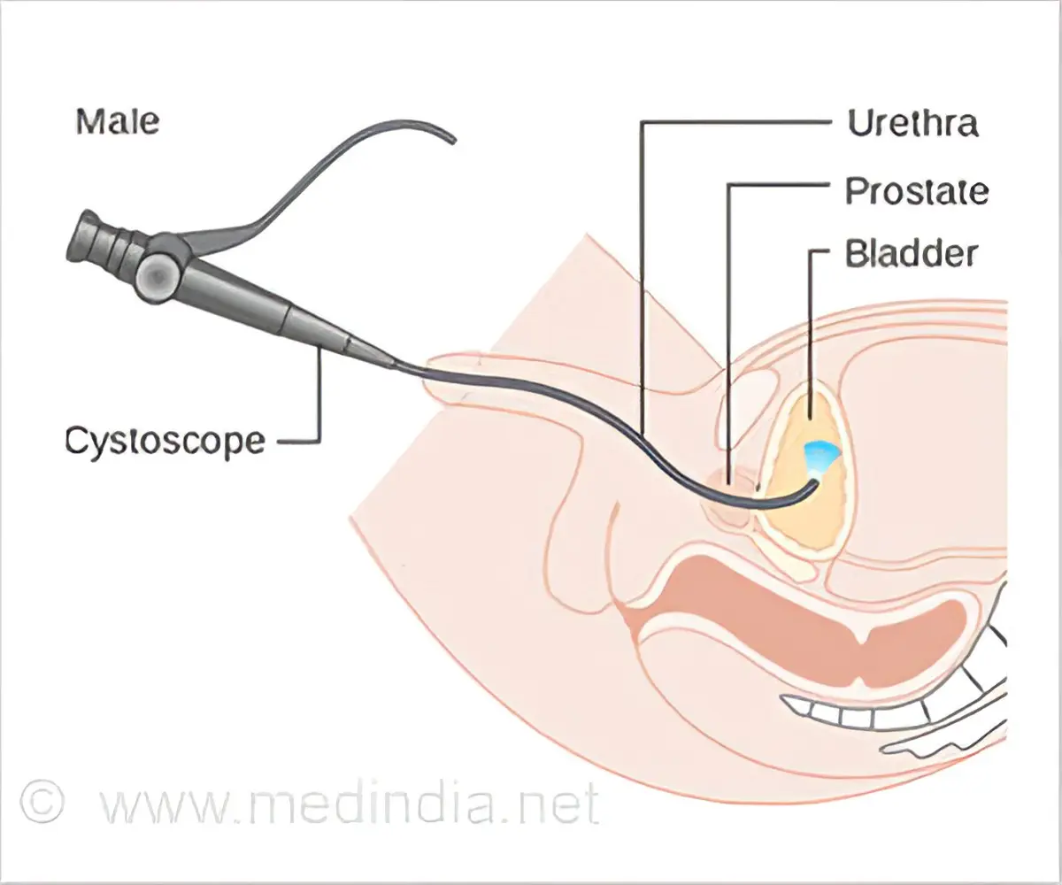 Cystoscopy &#8211; indications, price, course of examination. What are the complications?