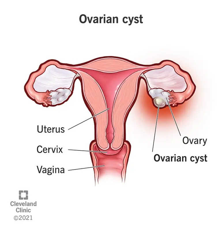 Cysts &#8211; types, symptoms and treatment. How are cysts formed?