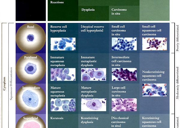 Cytology &#8211; course, results, interpretation. When to do a Pap test?