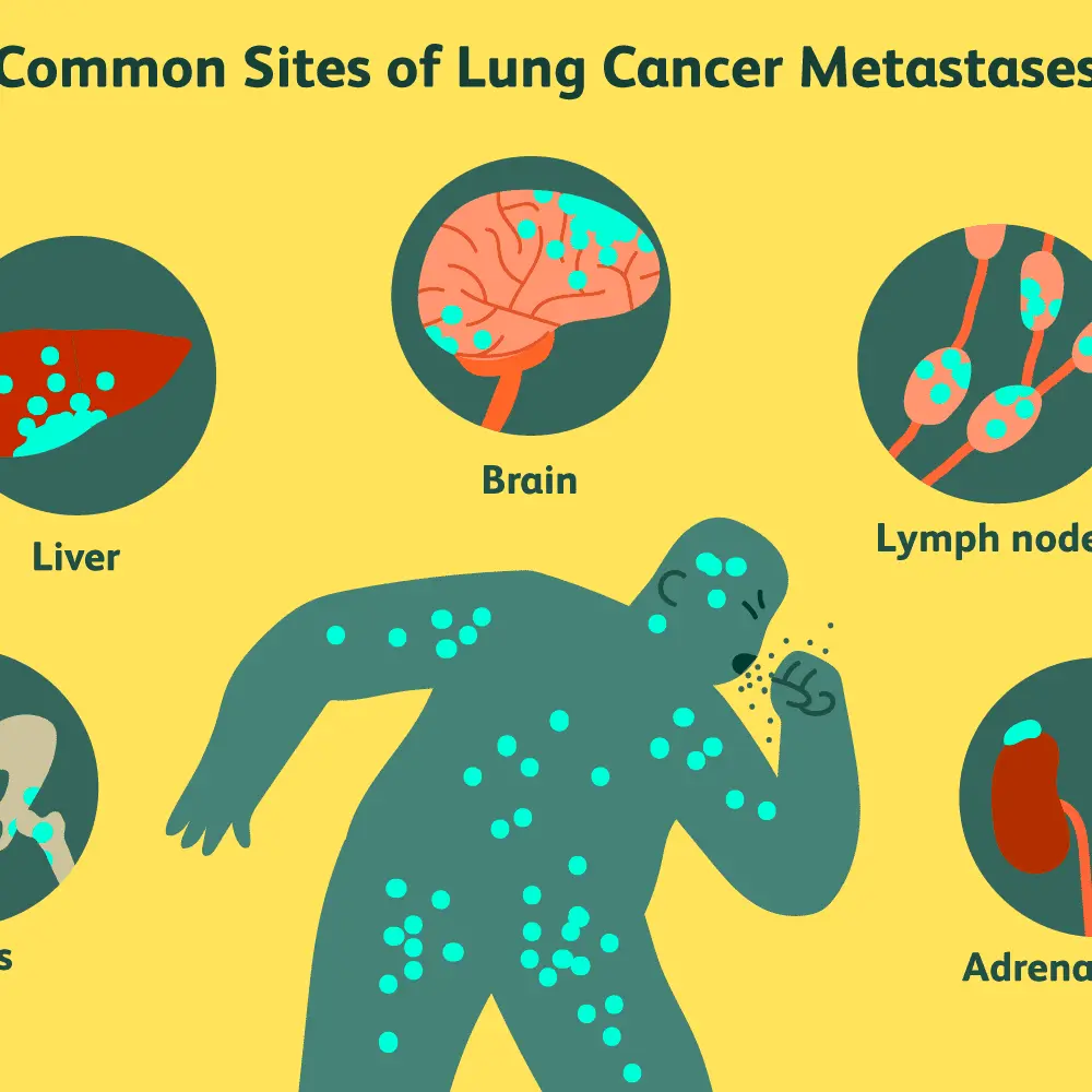 «Dad&#8217;s diagnosis: lung cancer with head metastasis. But the worst has just come ». [DAUGHTER&#8217;S LETTER]