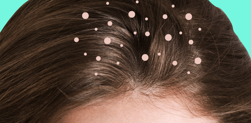 Dandruff &#8211; a scalp disease, but not only. What are the types, causes, and treatments for dandruff? WE EXPLAIN