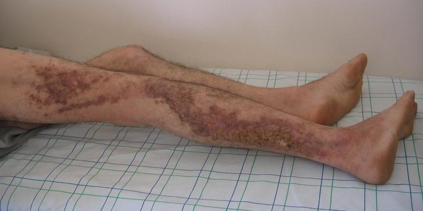 Darier&#8217;s disease