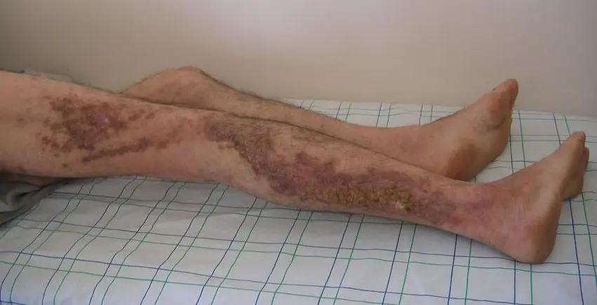 Darier&#8217;s disease