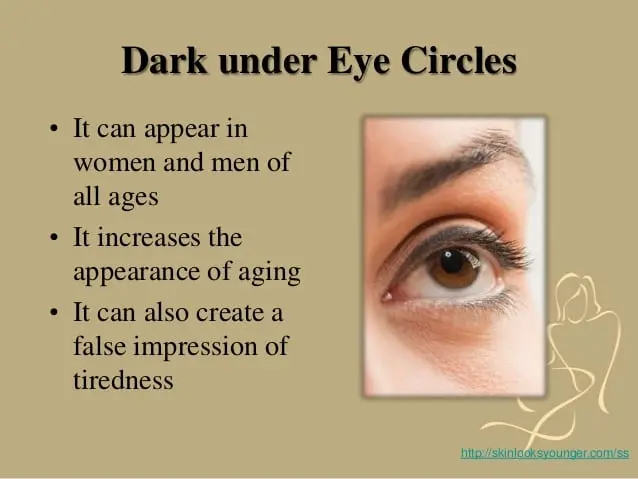 Dark circles under the eyes &#8211; causes and home remedies