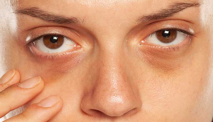 Dark circles under the eyes &#8211; what to check if they have appeared recently