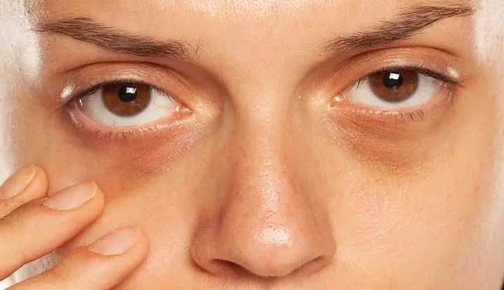 Dark circles under the eyes &#8211; what to check if they have appeared recently