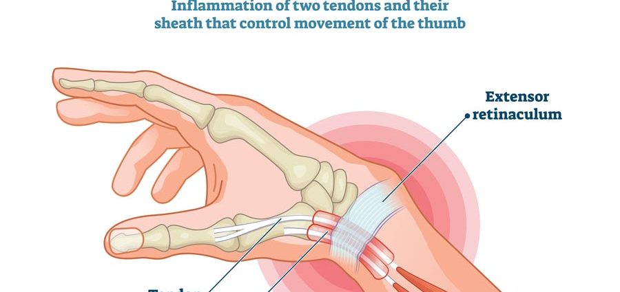 De Quervain&#8217;s syndrome &#8211; symptoms, causes, treatment