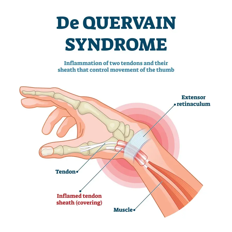 De Quervain&#8217;s syndrome &#8211; symptoms, causes, treatment