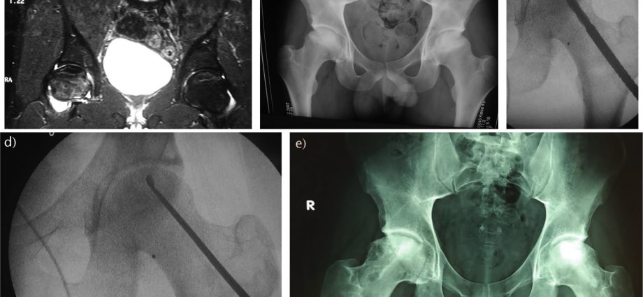 Decompression sickness &#8211; characters. First aid for aseptic osteonecrosis