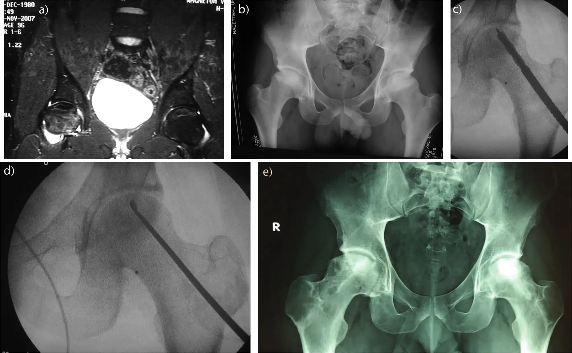 Decompression sickness &#8211; characters. First aid for aseptic osteonecrosis