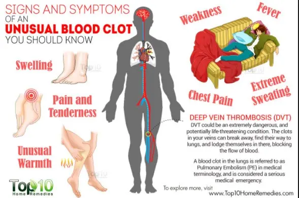 Deep vein thrombosis &#8211; symptoms, causes, treatment