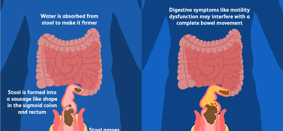 Defecation &#8211; the most common problems. How to take care of regular defecation?