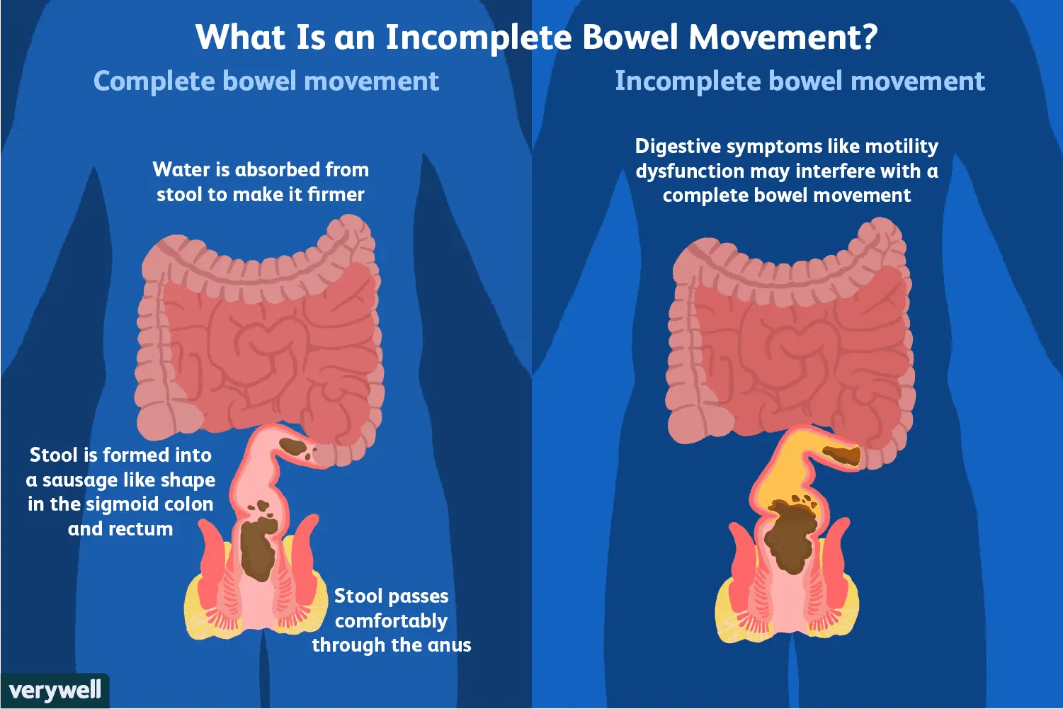 Defecation &#8211; the most common problems. How to take care of regular defecation?