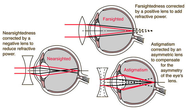 Defect of vision. Types of vision defects and ways to compensate for them