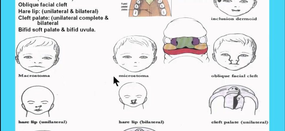 Defects of the face and palate