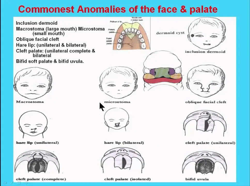 Defects of the face and palate