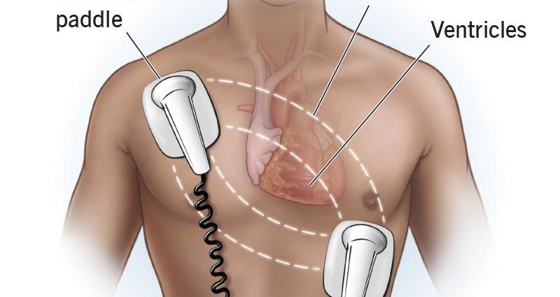 Defibrillation &#8211; what is it?