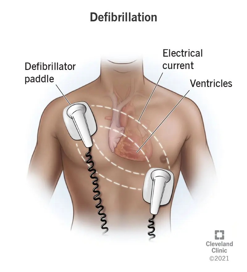 Defibrillation &#8211; what is it?