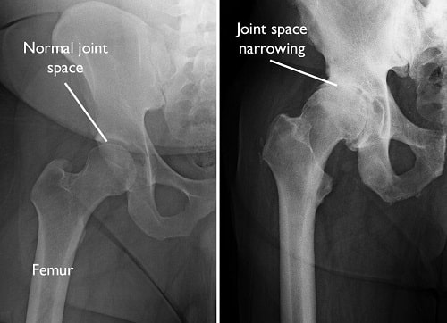 Degeneration of the hip joints