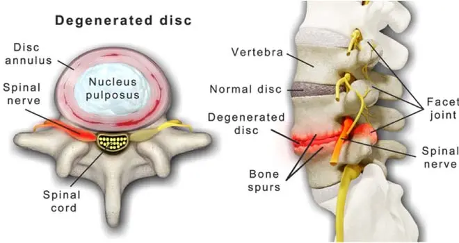 Degeneration of the joints of the spine &#8211; diagnosis, treatment