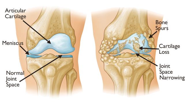 Degeneration of the knee joints &#8211; symptoms, treatment