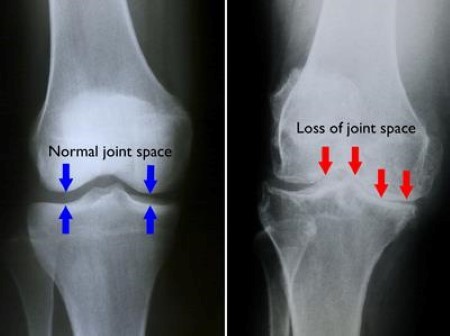 Degeneration of the knee joints