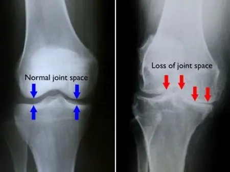 Degeneration of the knee joints