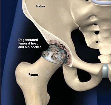 Degenerative and deforming changes in the hips