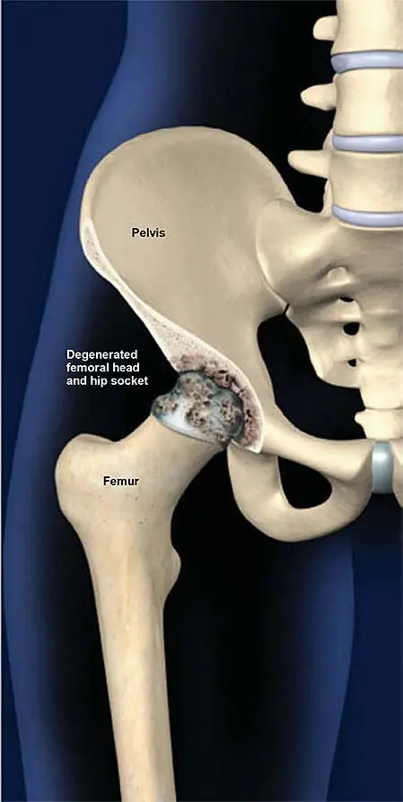 Degenerative and deforming changes in the hips