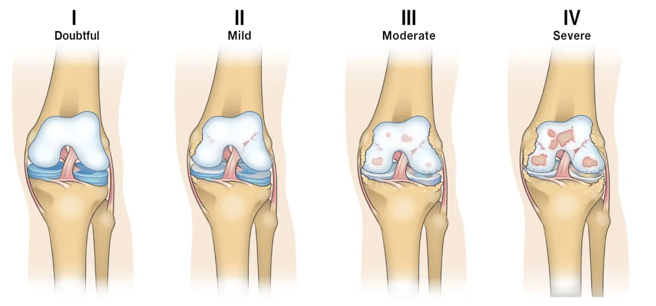 Degenerative-deforming changes of the knees