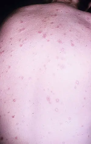 Degos disease