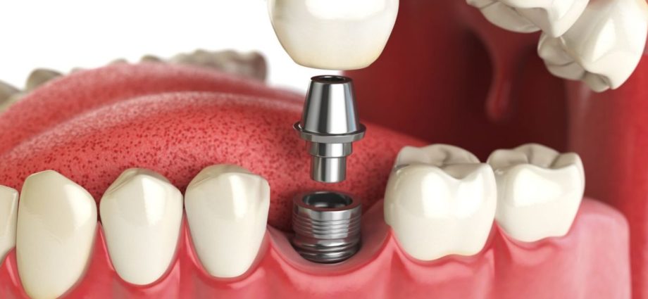 Dental implants &#8211; how much do they cost? What does the price of dental implants depend on?