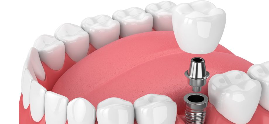 Dental implants &#8211; types and opinions. How much does the insertion of dental implants cost?