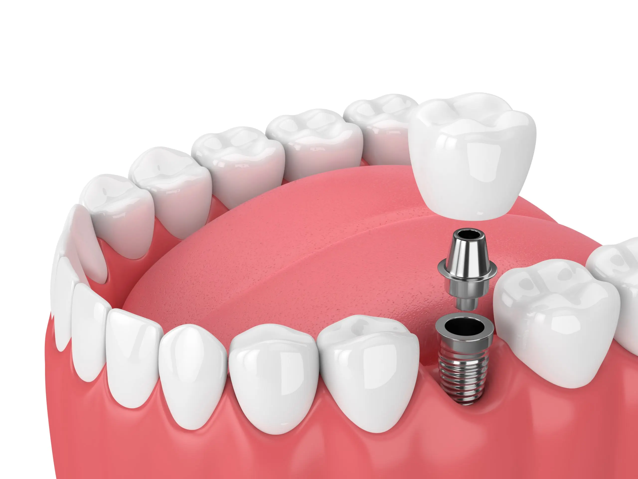 Dental implants &#8211; types and opinions. How much does the insertion of dental implants cost?