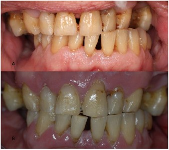 Dental implants were placed in the patient after face transplant