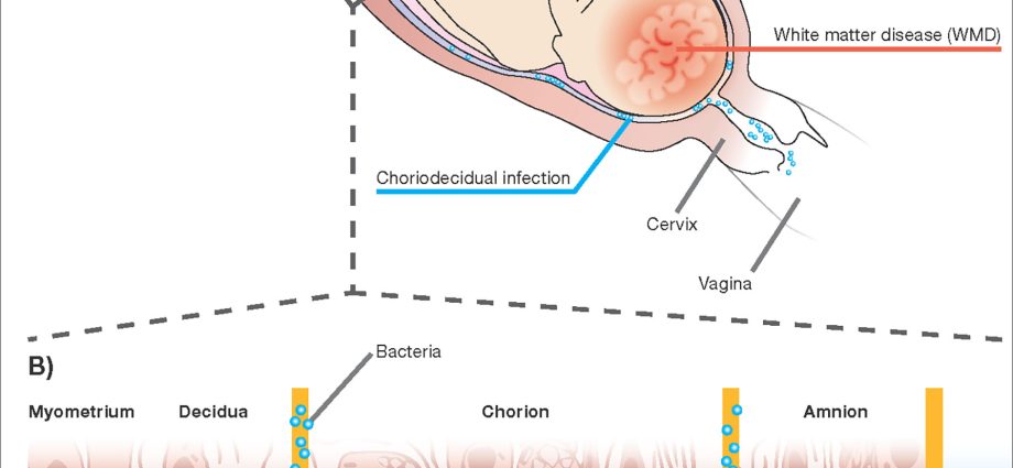 Departure of amniotic fluid &#8211; management, disturbing symptoms