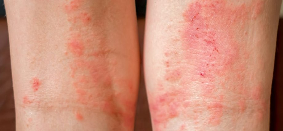 Dermatitis &#8211; causes, symptoms, diagnostics. How to cure sweating?